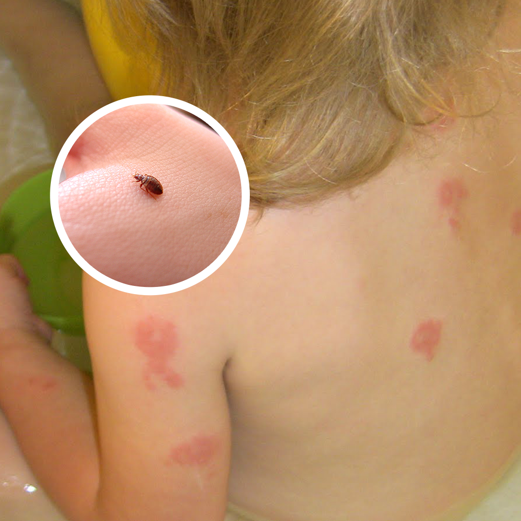What Does Bed Bug Bites Look Like on a Toddler: Clear Signs & Solutions