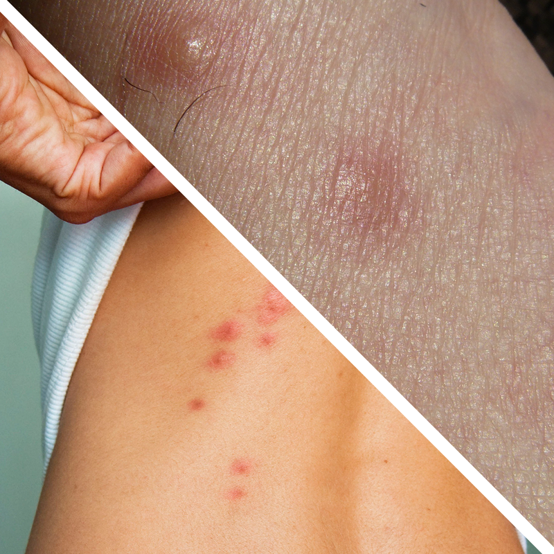 Bed Bug Bites vs Spider Bites: How to Differentiate the Two– Bed Bug SOS