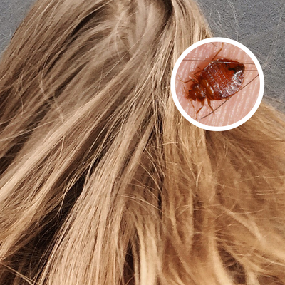 Bed Bugs or Lice? - Can Both Live in Human Hair?