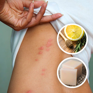 Bed Bug Bite Home Remedies You Can Try