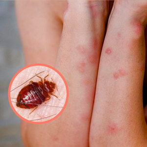 Tips to Prevent Bed Bug Bite Marks from Leaving Scars