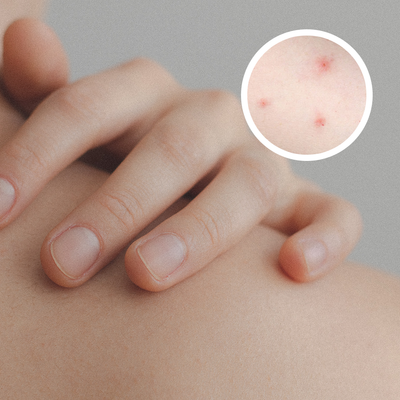 Bed Bug Bites – What Should You Do if You Get Them?