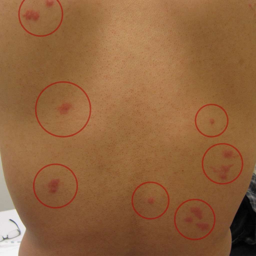 Bed Bug Bite Patterns – Bed Bug SOS