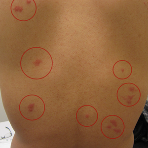 Bed Bug Bite Patterns