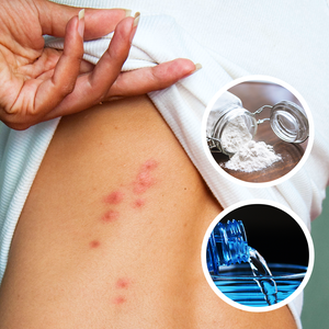 How to Get Rid of Bed Bug Bites