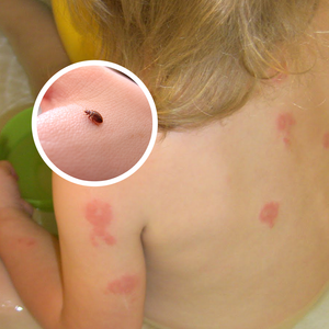 Bed Bug Bites on Kids