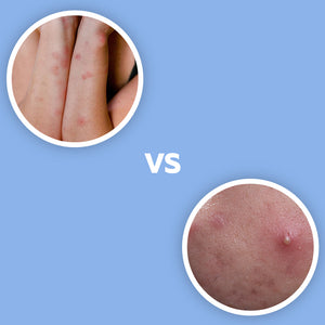 Bed Bug Bites VS Pimples