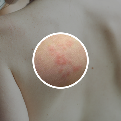 Rash Treatment for Bed Bugs - Quick Remedies to Relieve a Rash Caused by Bed Bugs