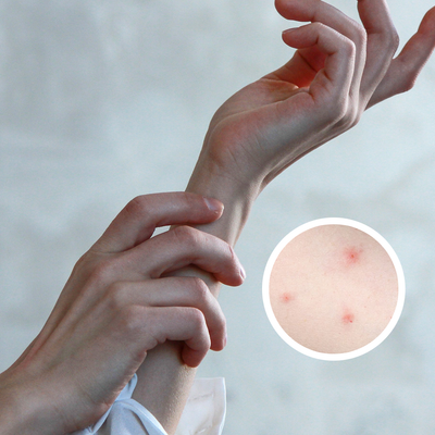 Is a Bed Bug Rash Normal?