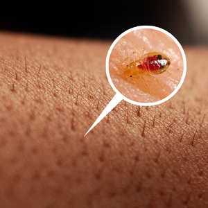 Can You Feel Bed Bugs Crawling on Your Skin?– Bed Bug SOS